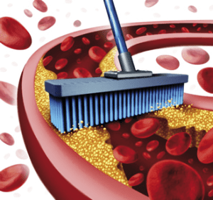 Cleaning Arteries